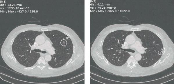 胸部のCT 胸部CTの適応と基本的読影4: やさしイイ呼吸器教室